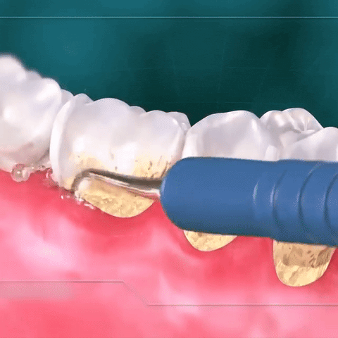 Electric Dental Calculus Remover